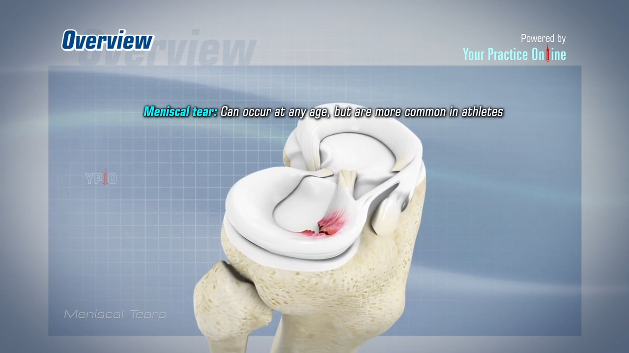Meniscal Tears Video | Medical Video Library