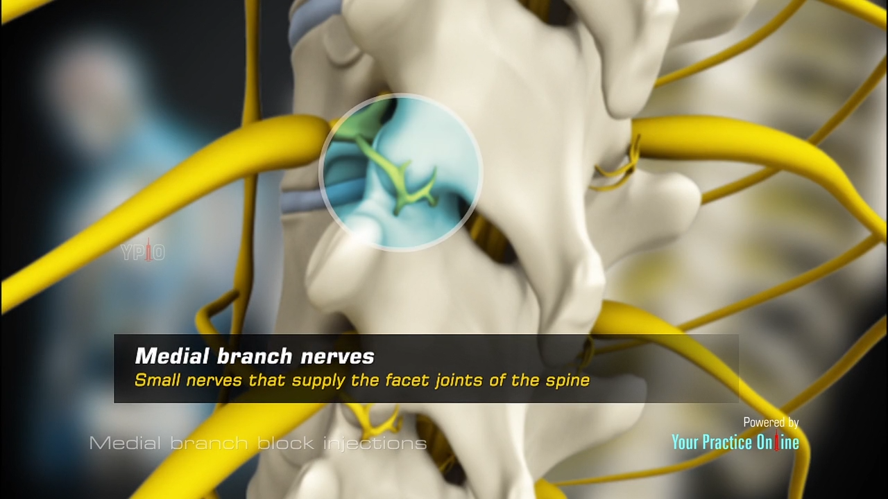 Medial branch block injections spinal injection video spinal pain