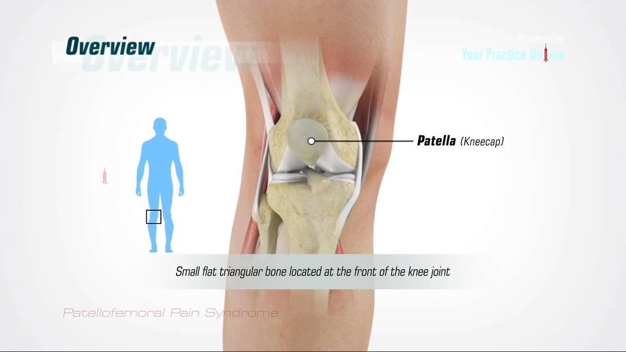 Patellofemoral Pain Syndrome Video | Medical Video Library