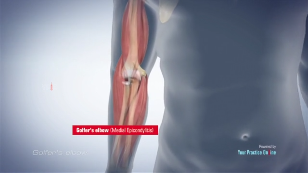 Golfer Elbow Video Medical Video Library
