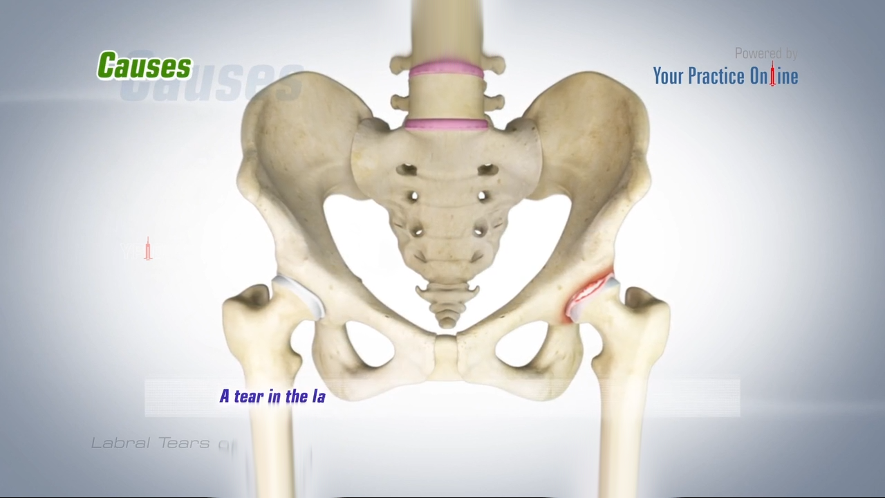 Labral Tears of the Hip Video Medical Video Library