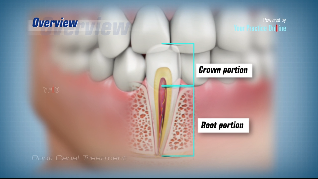 Root Canal Video | Tooth Decay Treatment Video | Dental Video Library