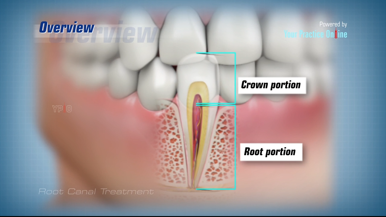 root canal treatment near me