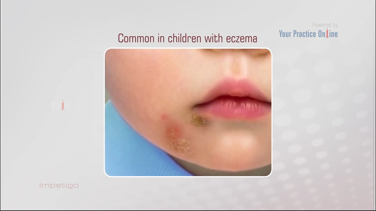 impetigo in children face