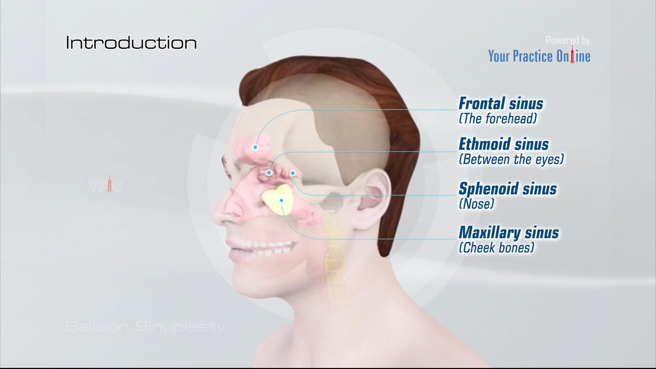 Balloon Sinuplasty Video Minimally Invasive Surgery