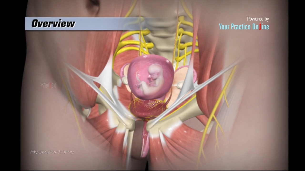 Hysterectomy Video | Medical Video Library