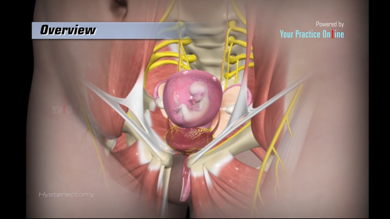 laparoscopic hysterectomy before and after