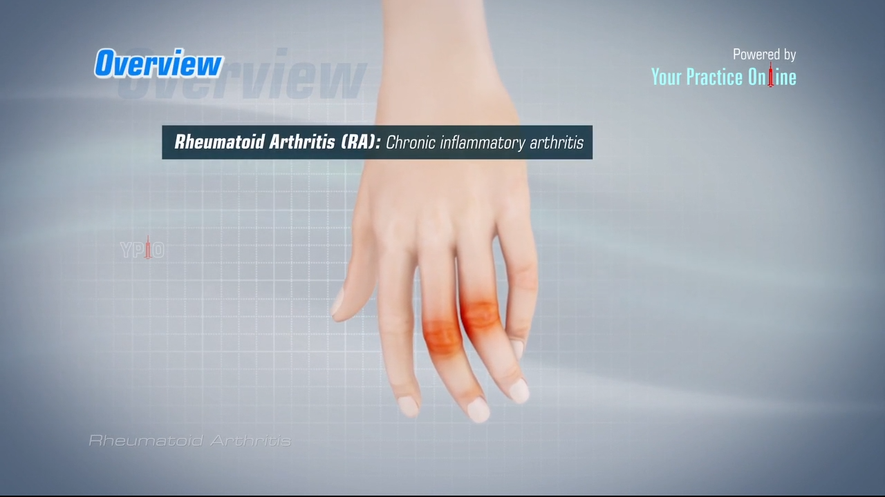 Rheumatoid Arthritis Video | Rheumatology | RA Treatments