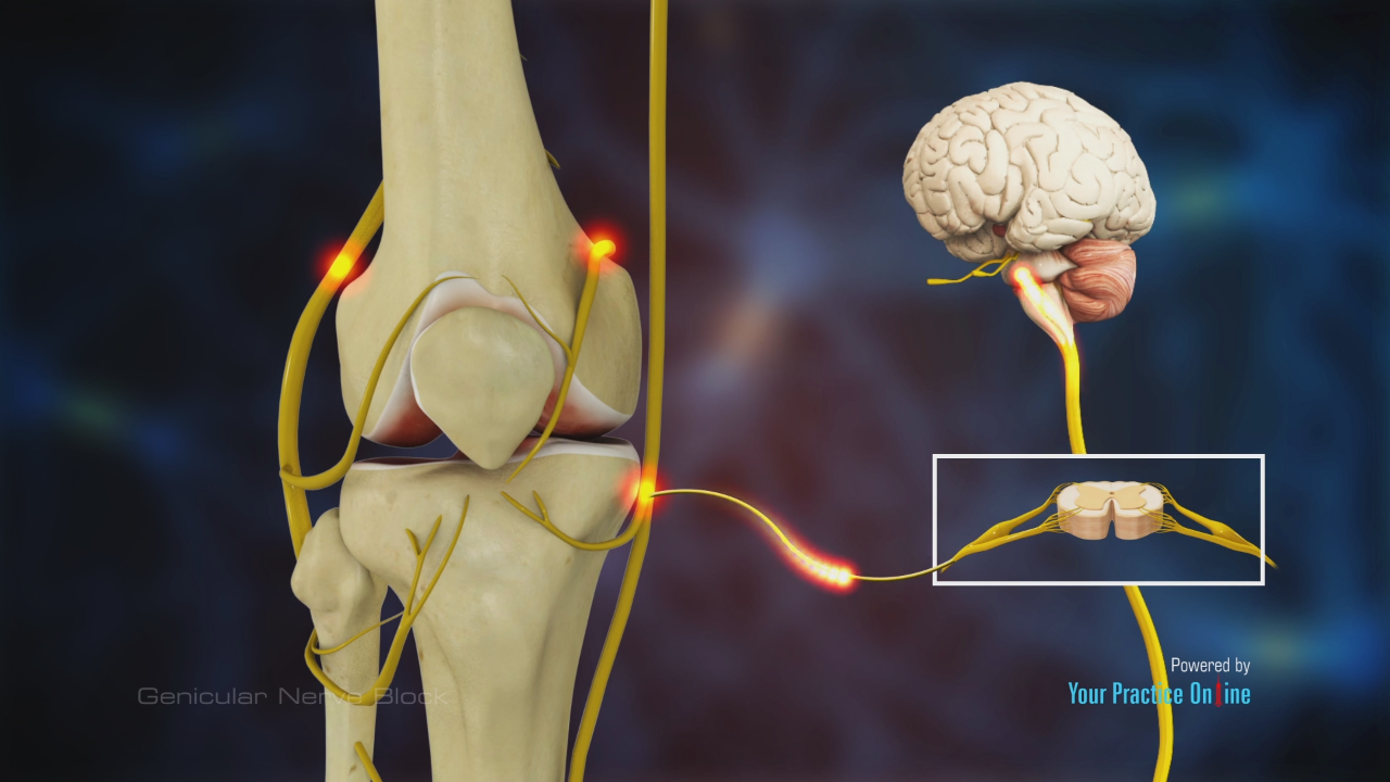 Genicular Nerve Block Video | Medical Video Library