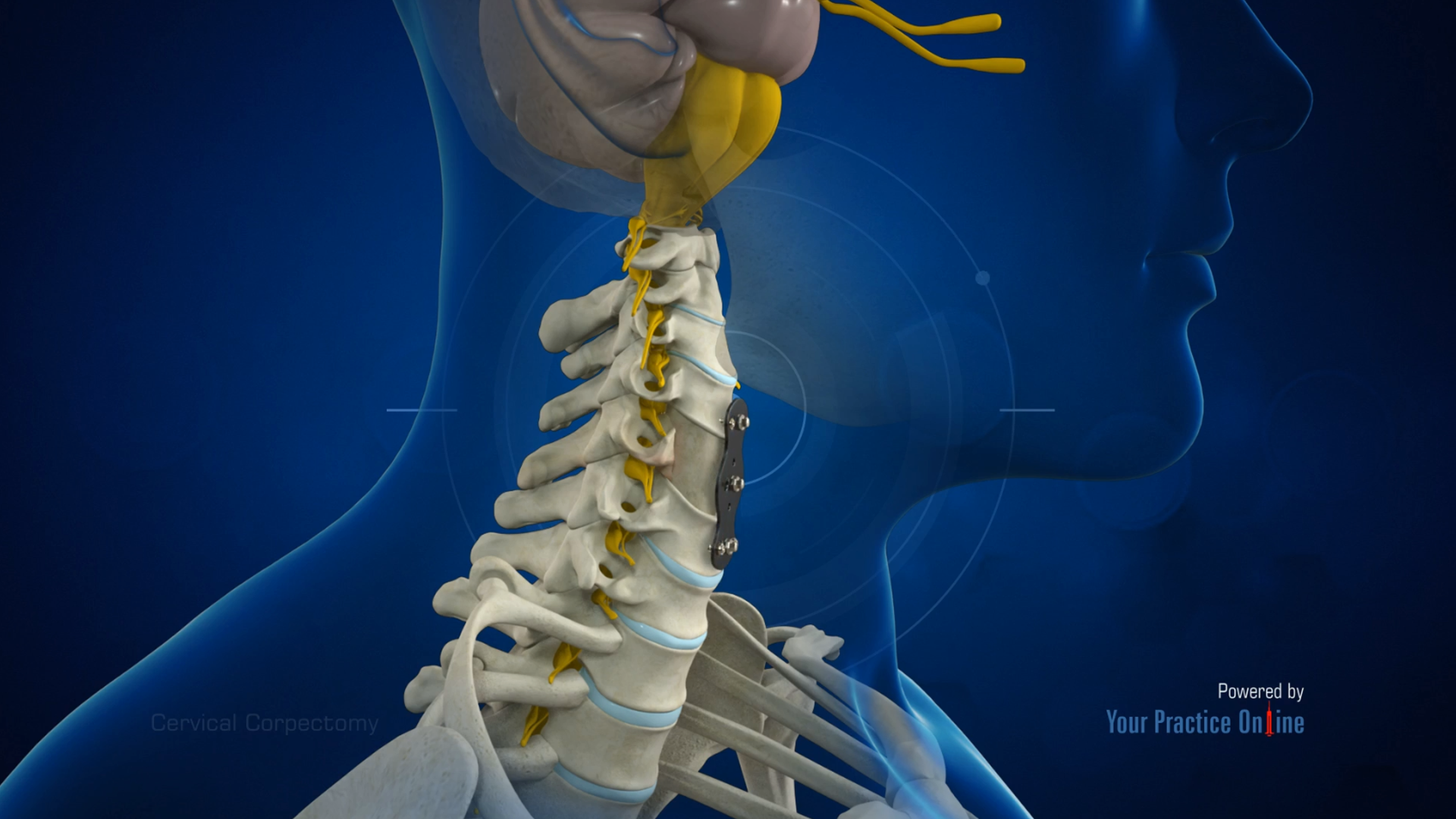 Cervical Corpectomy Video | Medical Video Library
