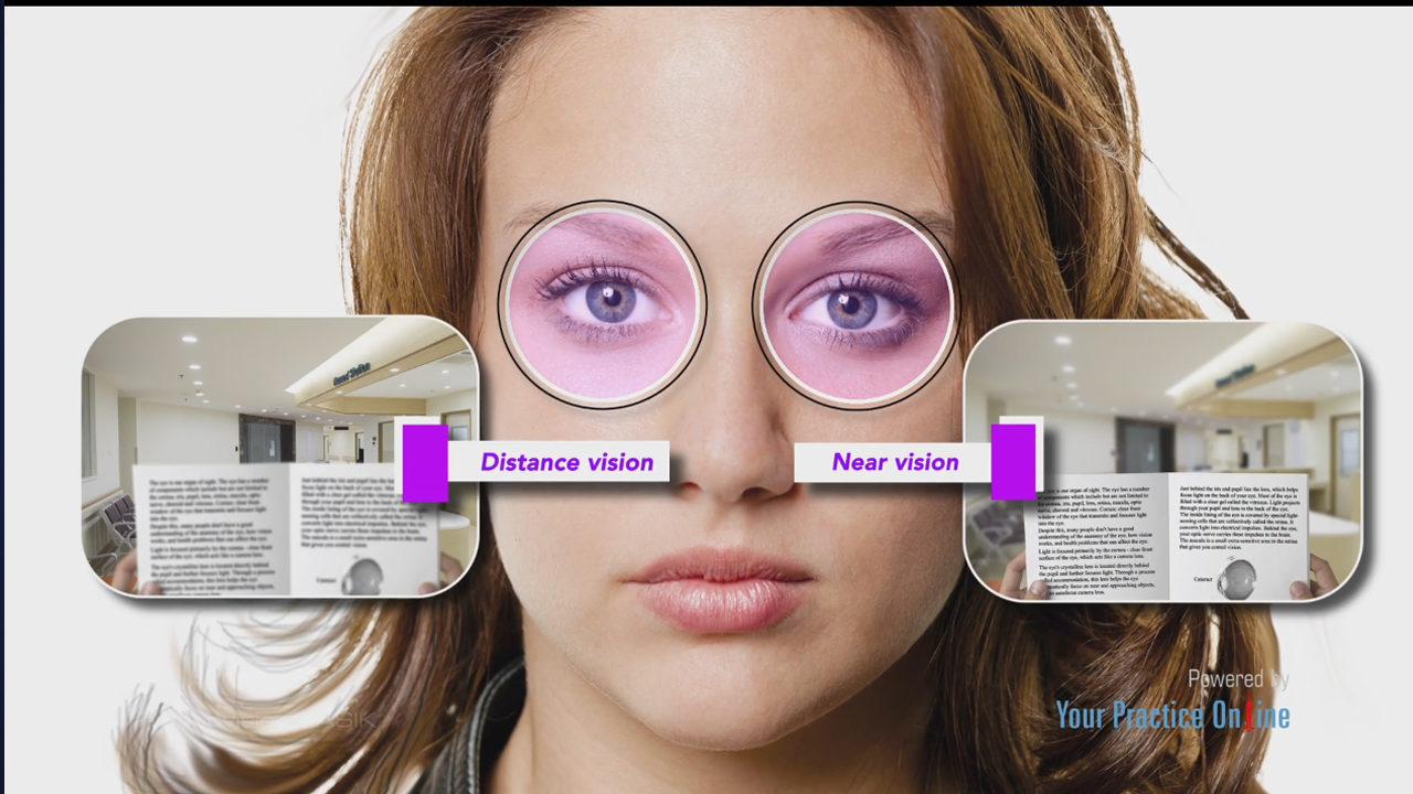 Monovision lasik discount