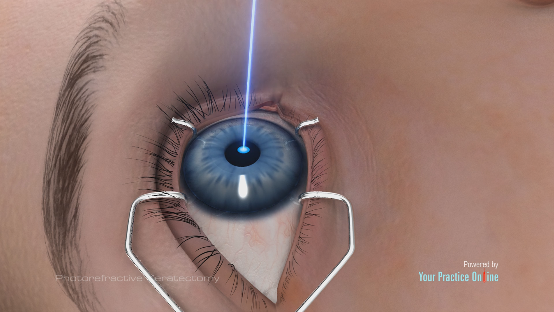 Photorefractive keratectomy