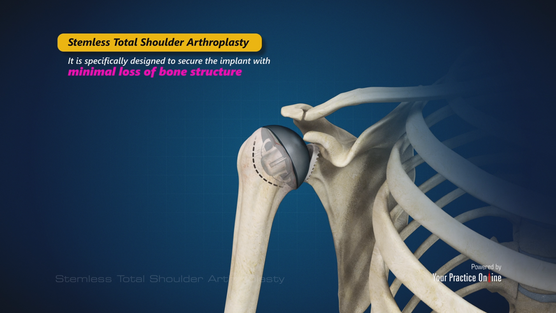 Stemless Total Shoulder Arthroplasty Video Medical Video Library