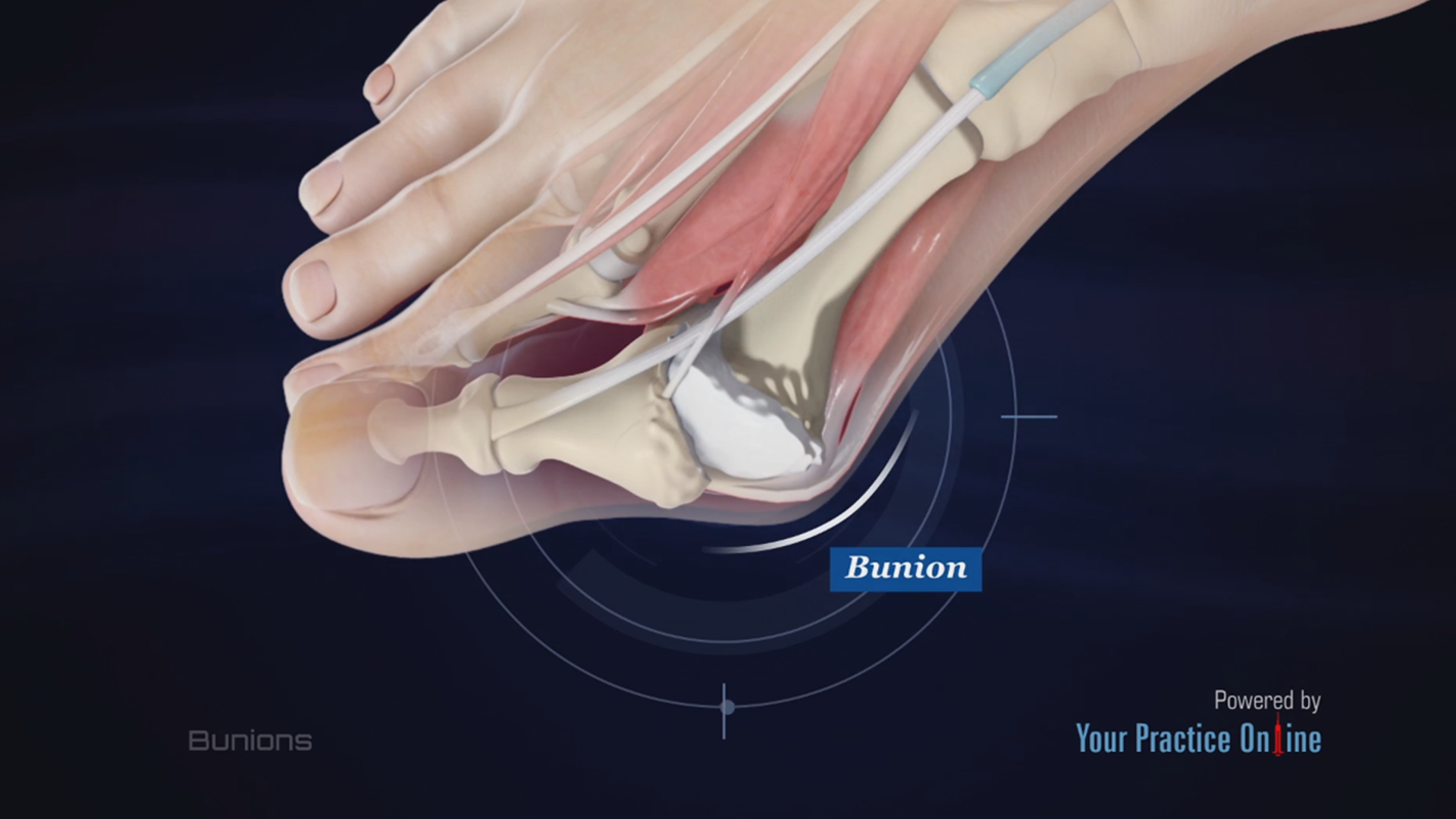 Bunions video thumbnail