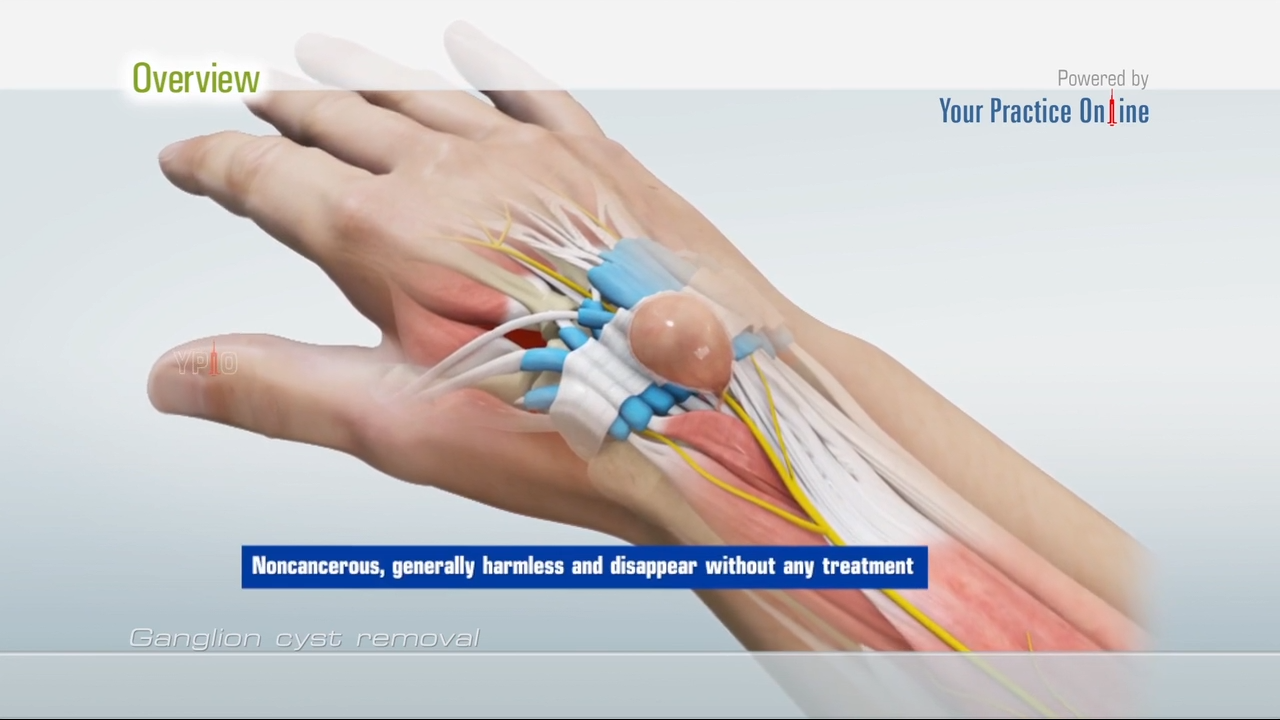 Ganglion home cyst wrist remedies for on Ganglion Cyst