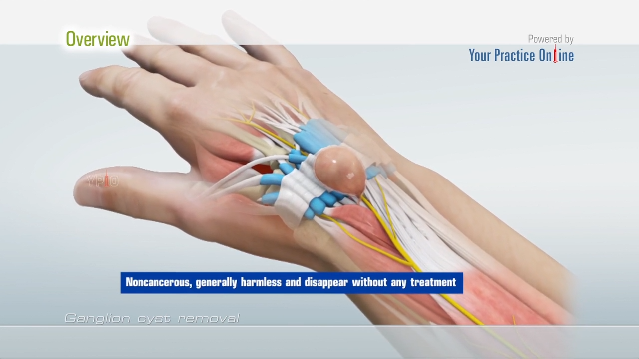 Ganglion Cyst Removal Video | Medical Video Library