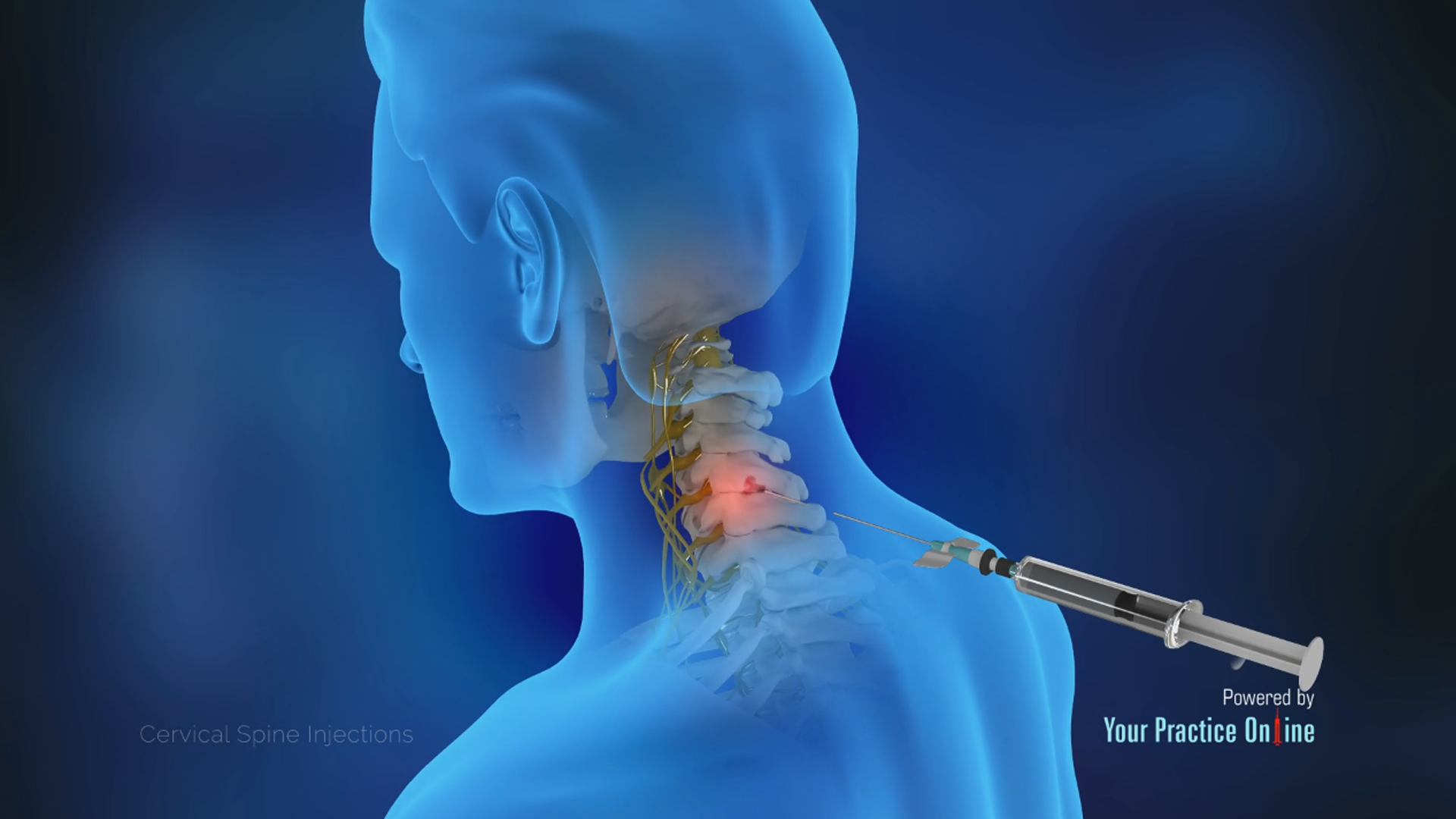 Cervical Spine Injections Video Medical Video Library
