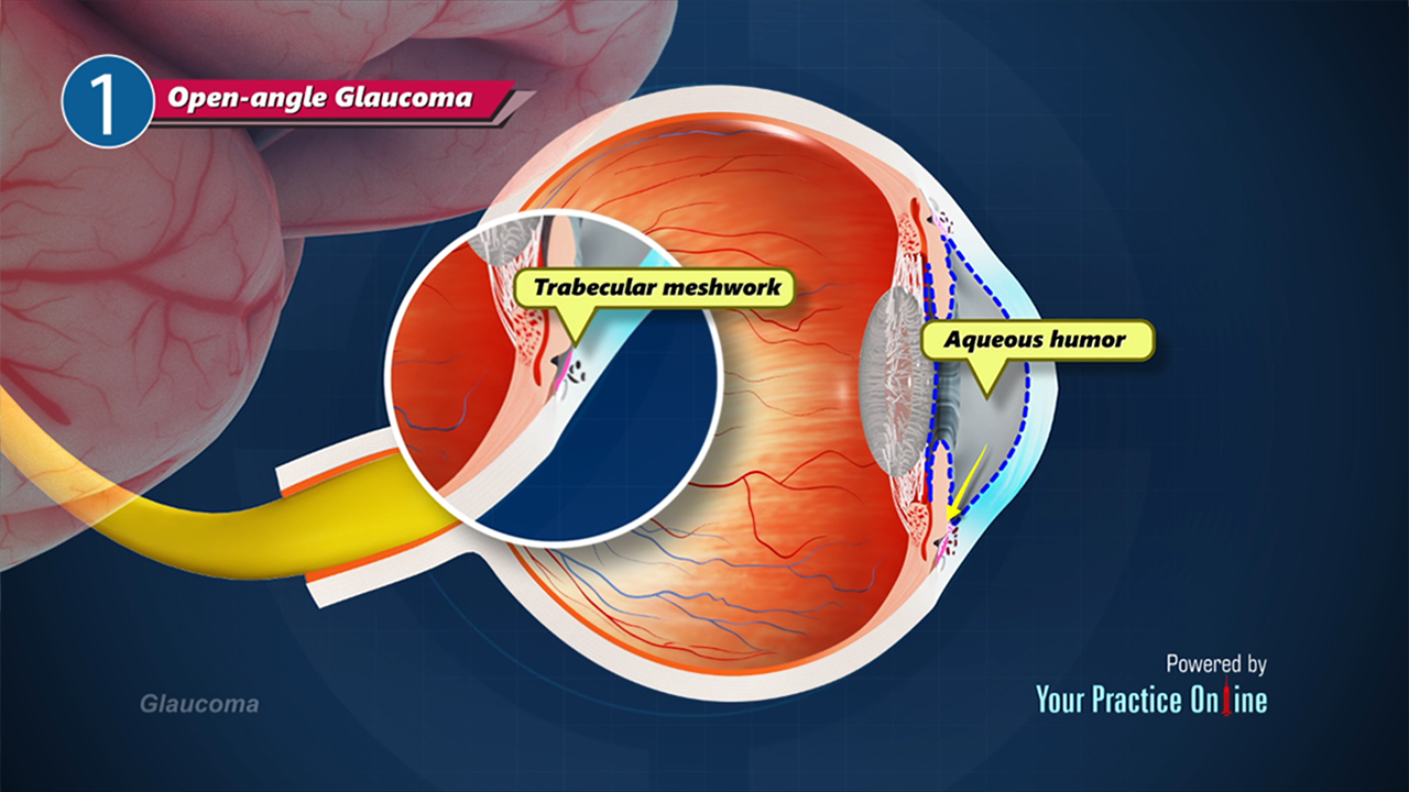 Glaucoma Video | Medical Video Library