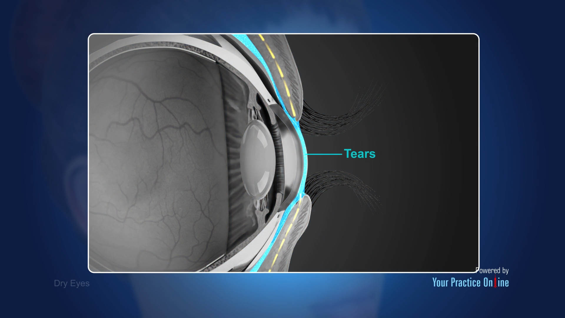 Dry Eyes Video | Medical Video Library