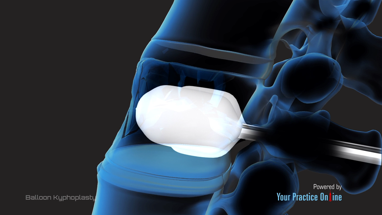 Balloon Kyphoplasty Video Medical Video Library