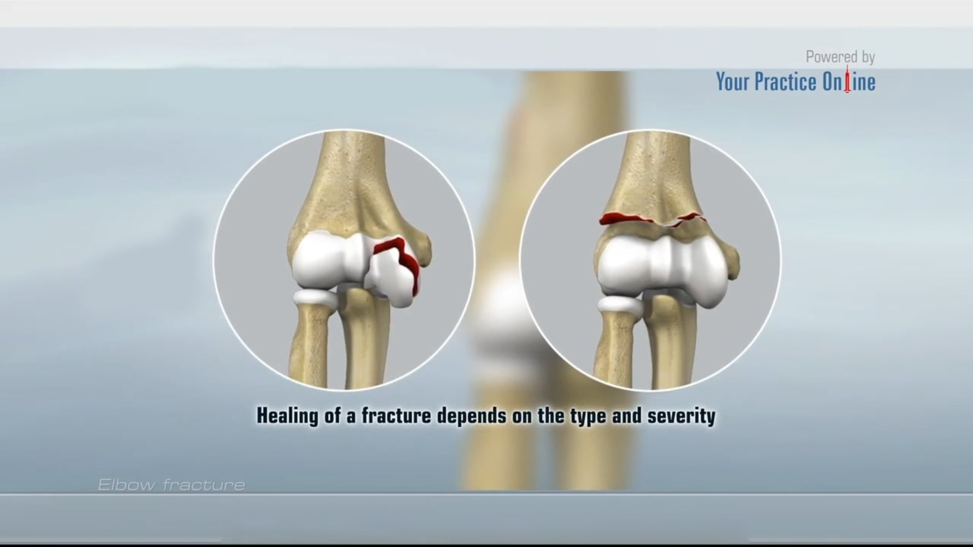 Elbow Fracture Video Medical Video Library