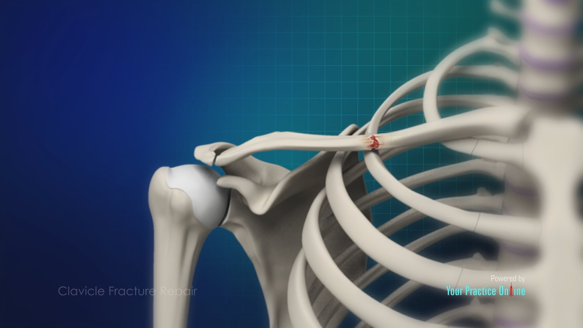 Clavicle Fracture Video | Medical Video Library
