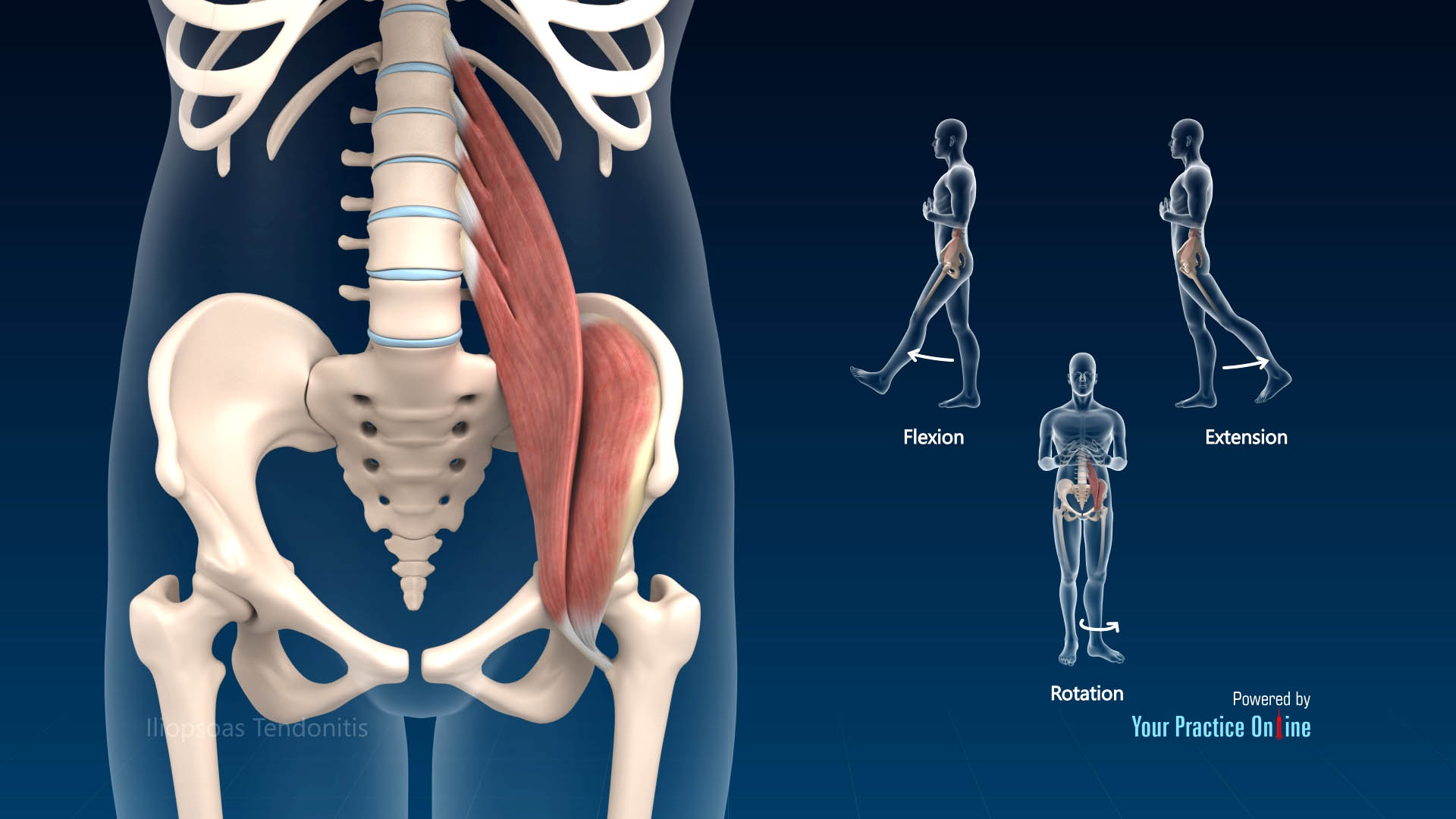 Groin Tendinitis