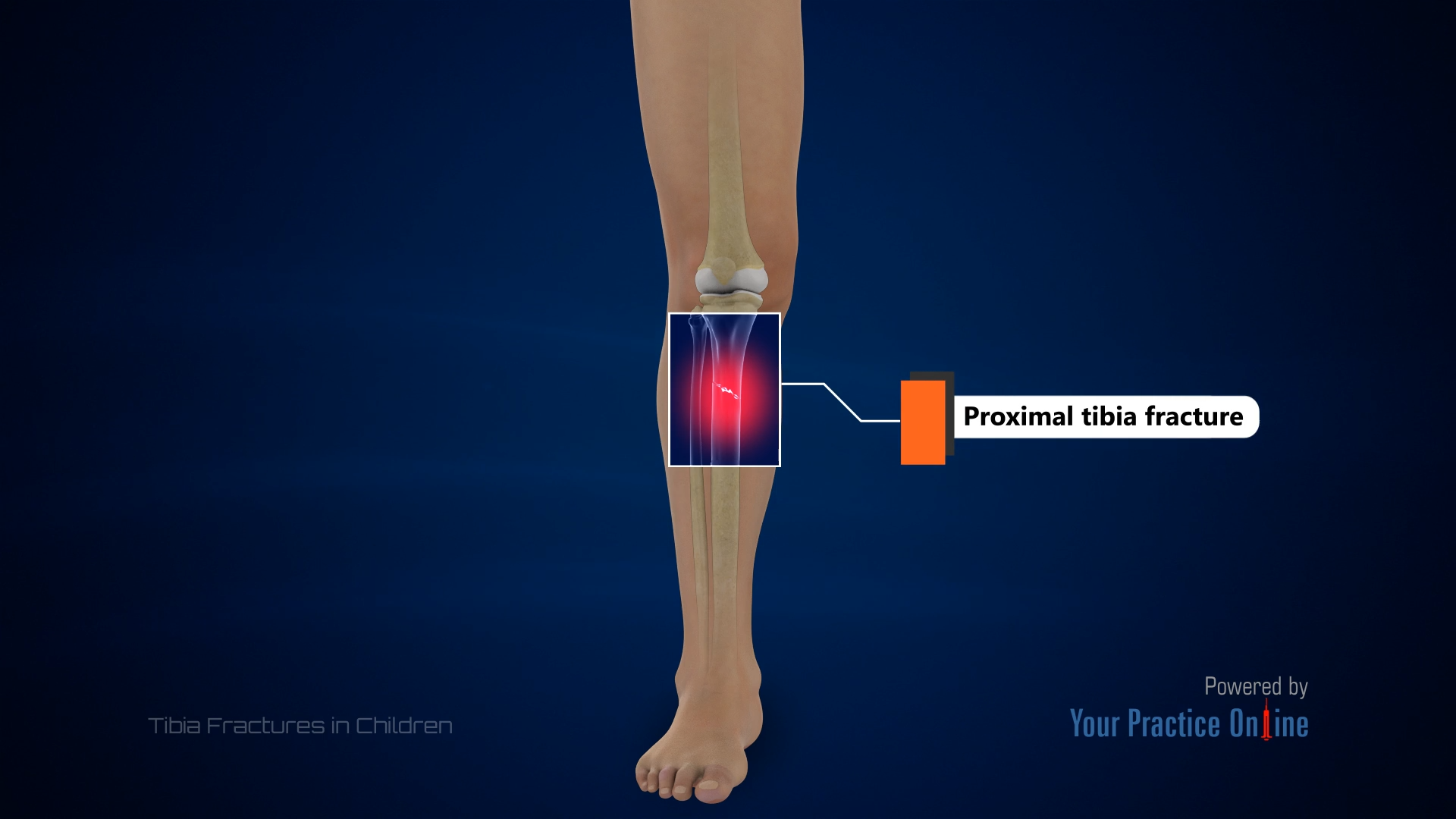 Tibia Fractures in Children Video | Medical Video Library