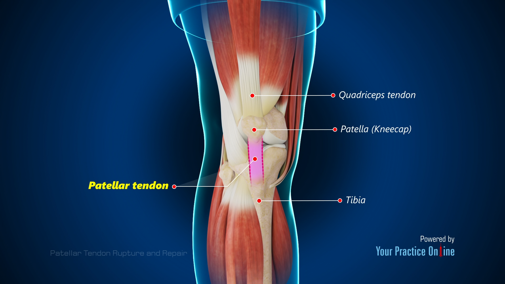 Patellar Tendon Rupture And Repair Video Medical Video Library