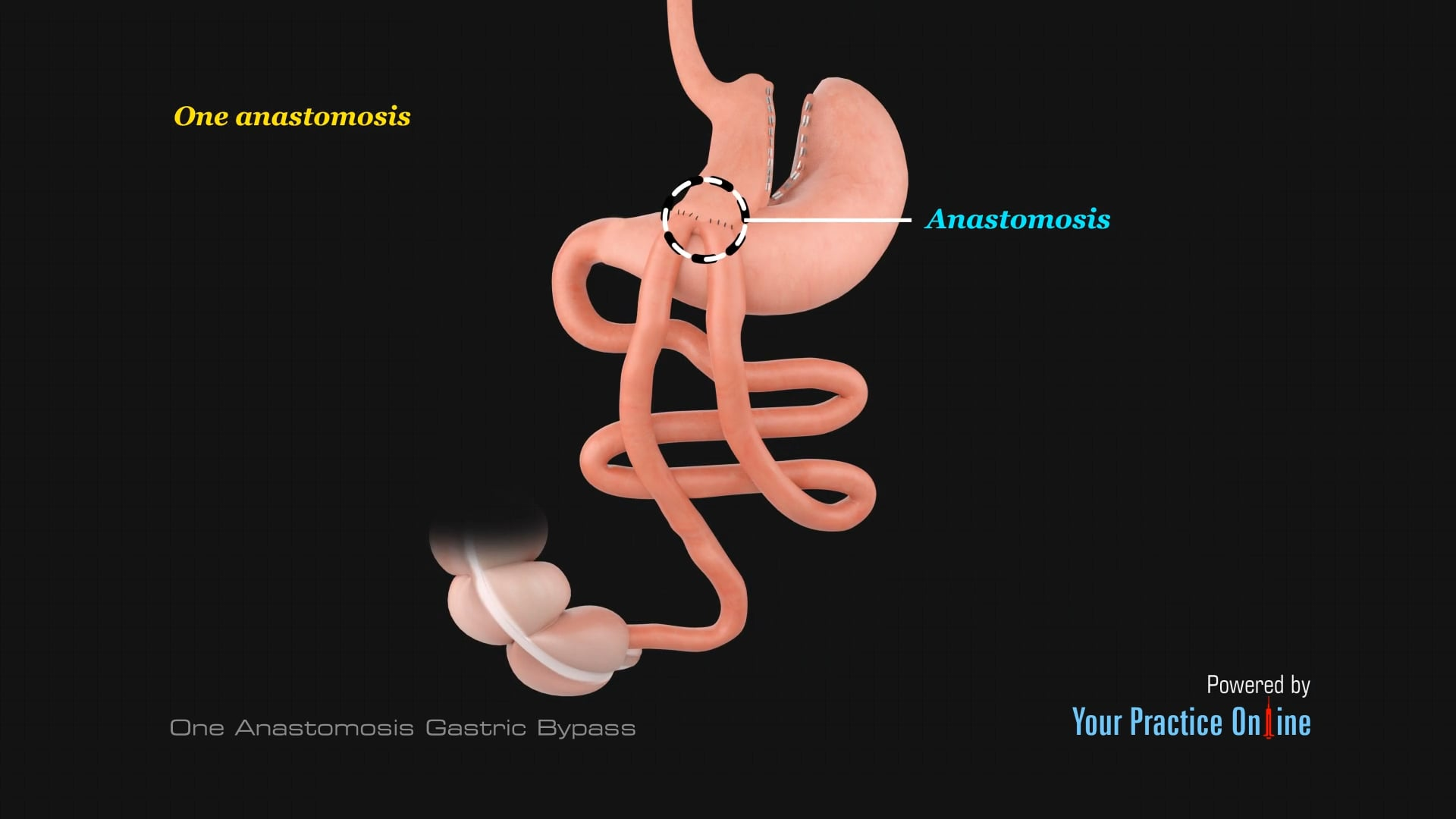 Gastric Anastomosis gastric-anastomosis