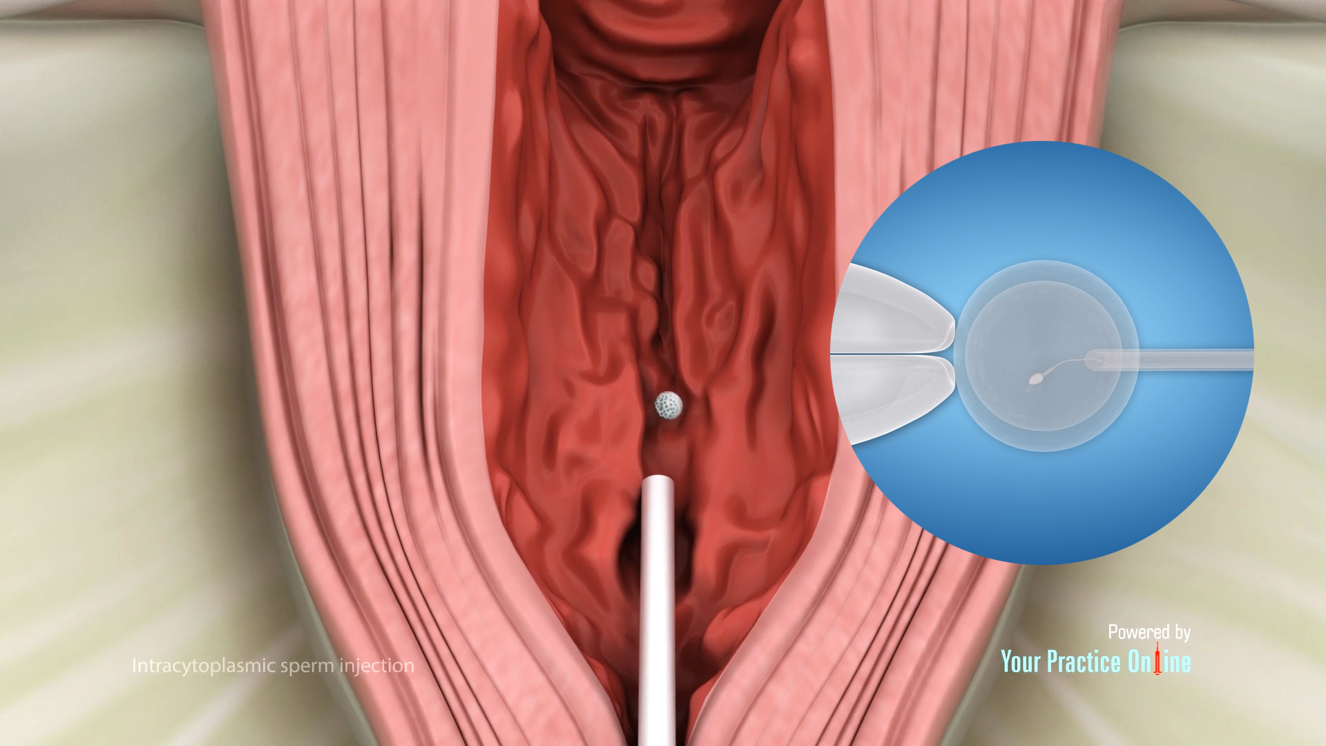 Injecting Sperm Into Vagina Injecting Sperm Into Vagina