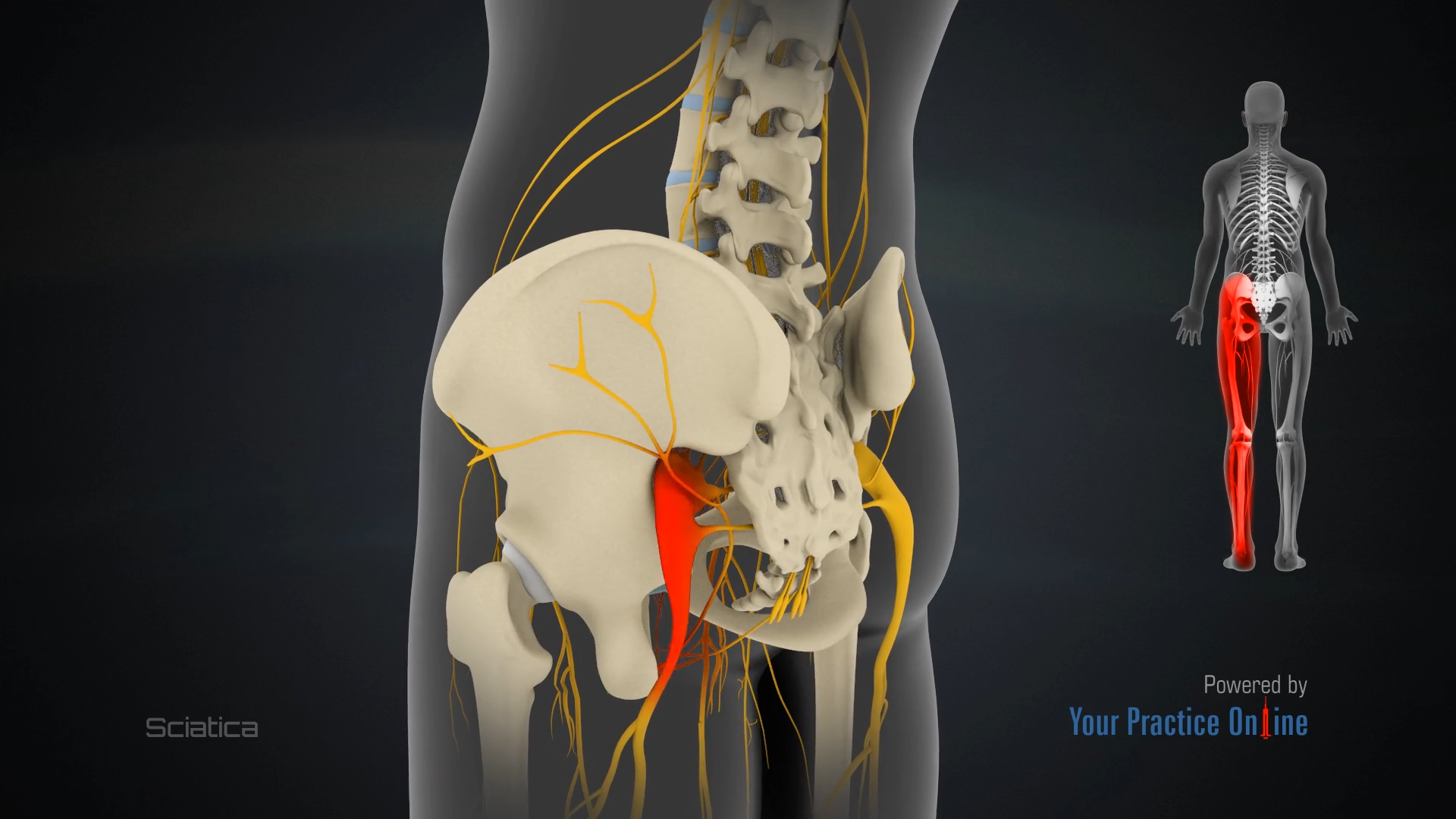 Sciatica Video | Medical Video Library