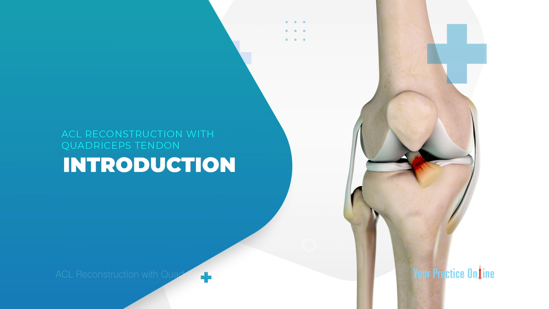 ACL Reconstruction with Quadriceps Tendon Video Medical Video Library