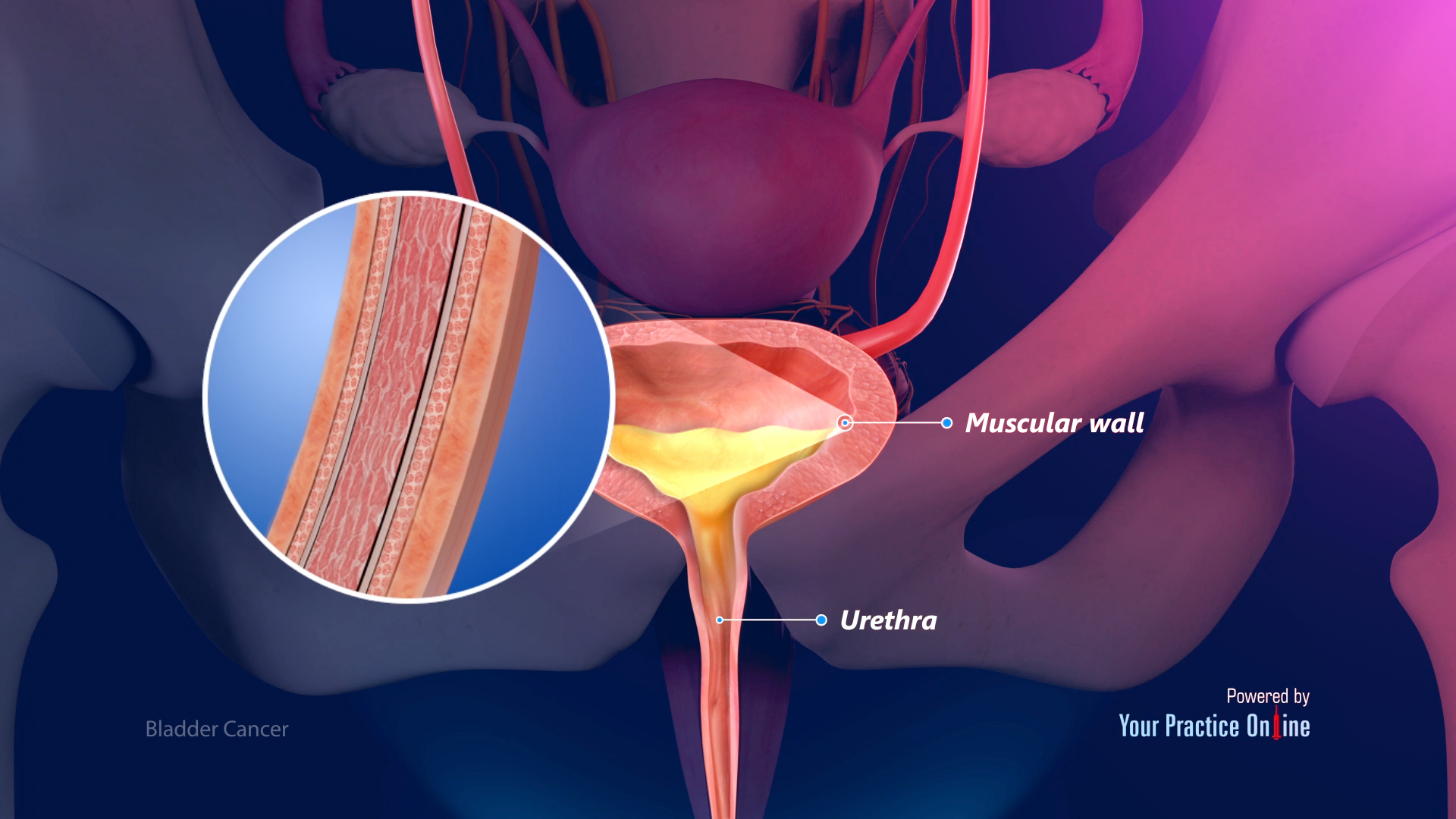 Bladder Cancer Video | Medical Video Library