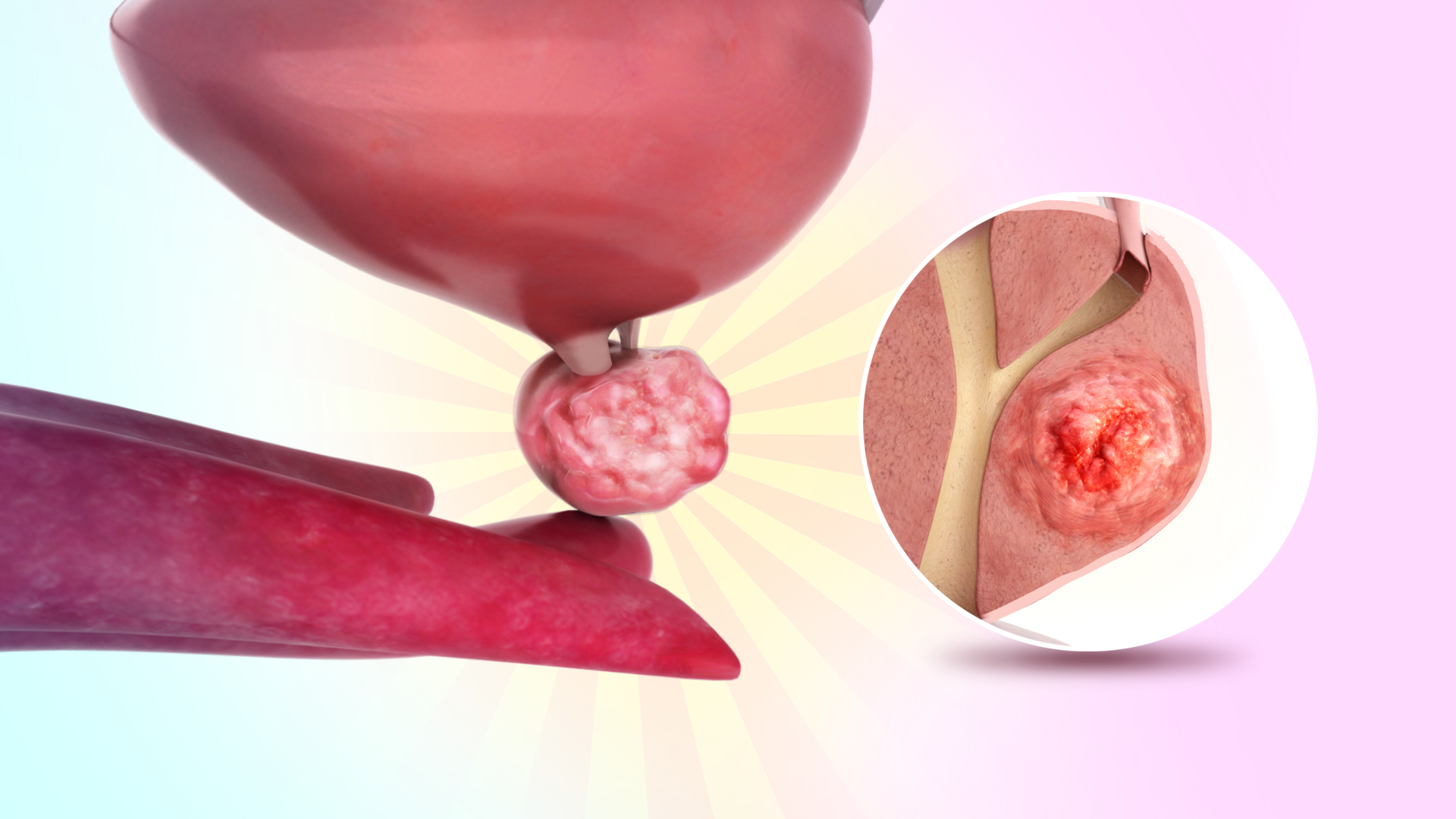 Prostate Cancer Video | Medical Video Library