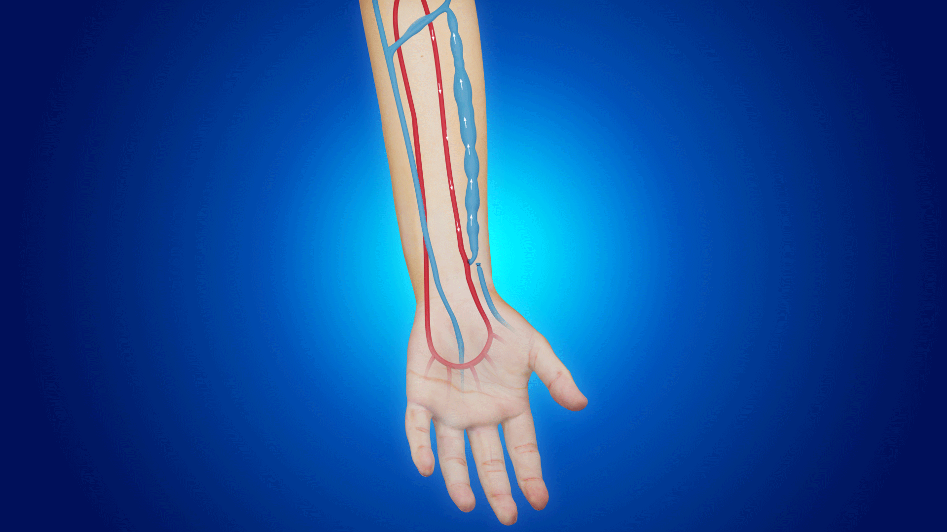Arteriovenous Fistula Creation Video Medical Video Library