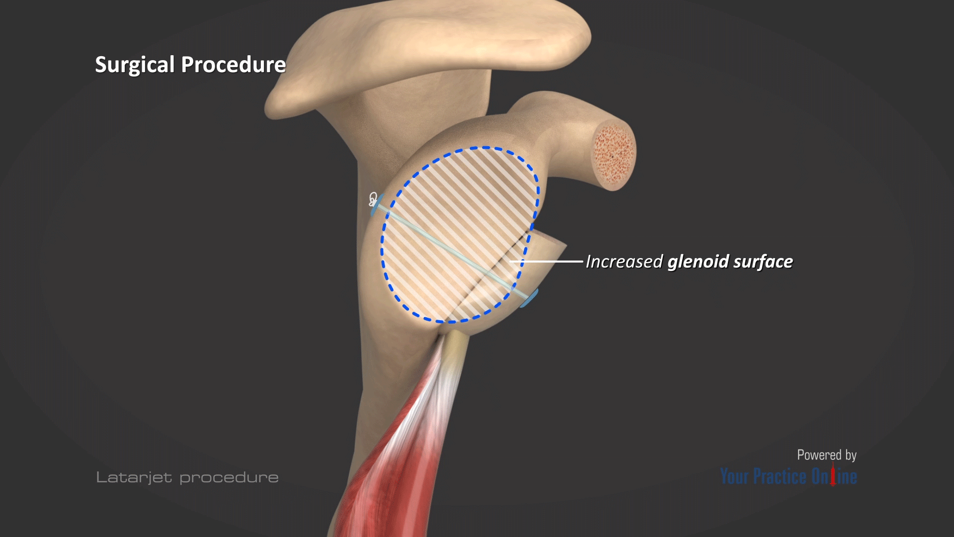 Latarjet Procedure Video | Medical Video Library