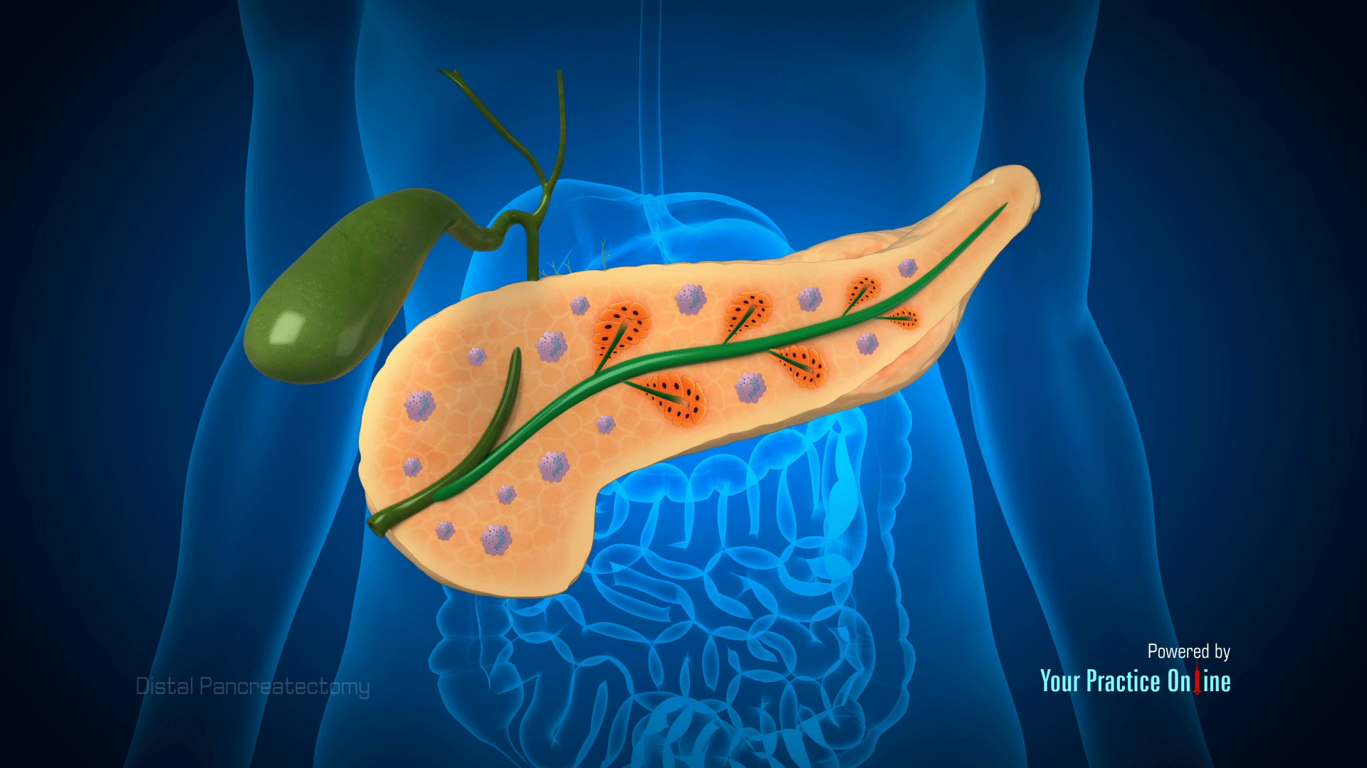 Distal Pancreatectomy Video Medical Video Library