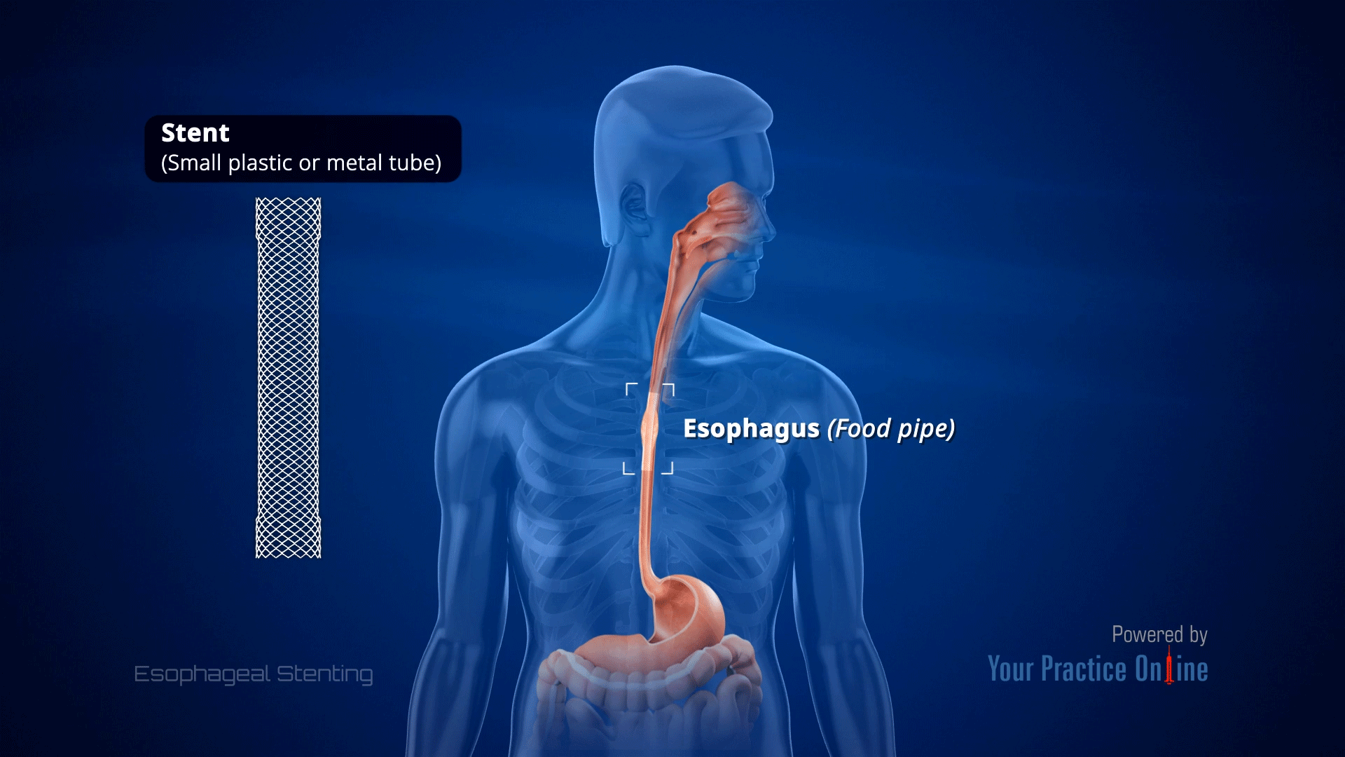 Esophageal Stenting Video Medical Video Library esophageal-stenting-video-medical-video-library