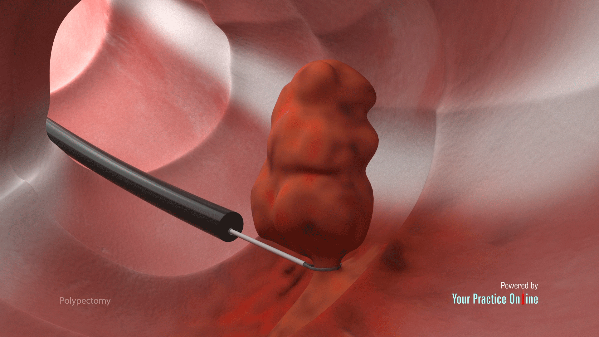 Do You Need Surgery To Remove Large Colorectal Polyps 54 OFF