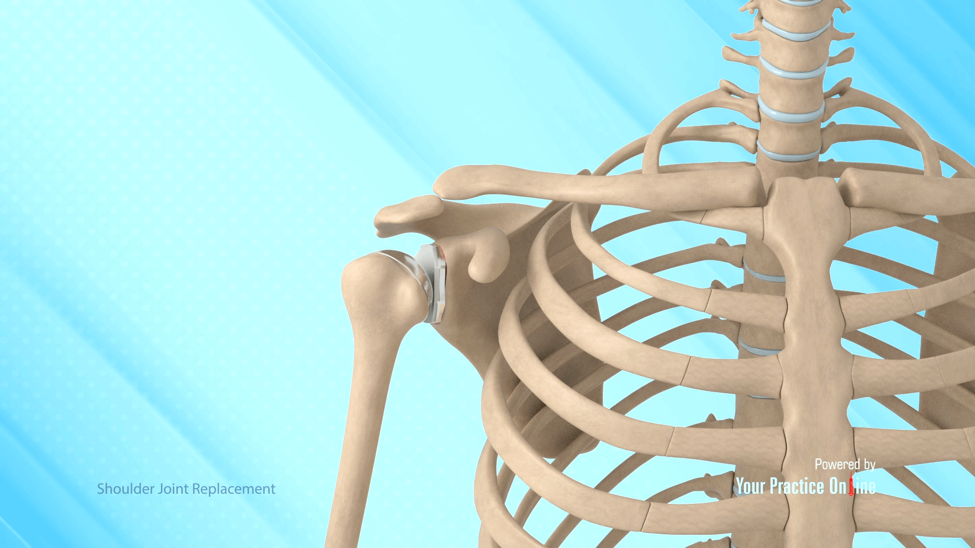 Shoulder Joint Replacement Video | Medical Video Library