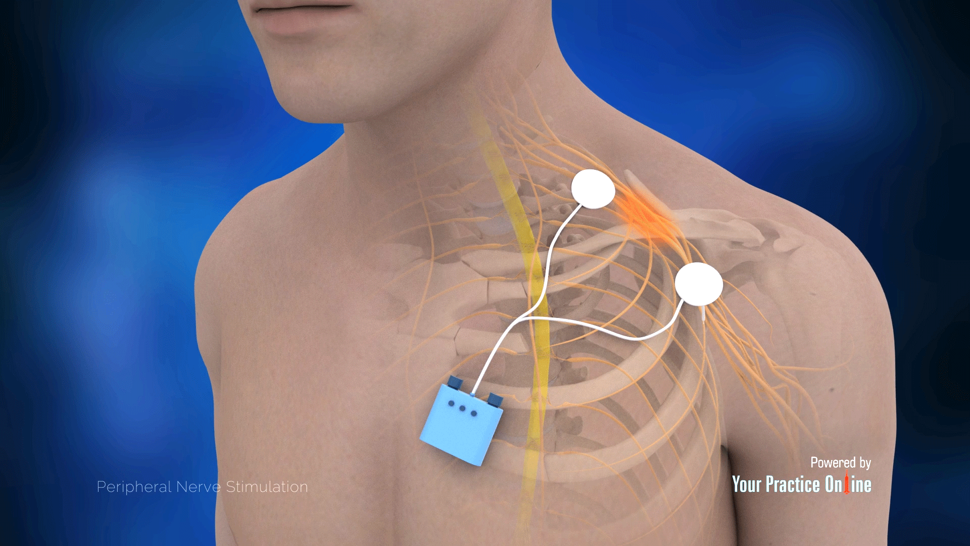 Nerve Stimulation Devices for Chronic Pain