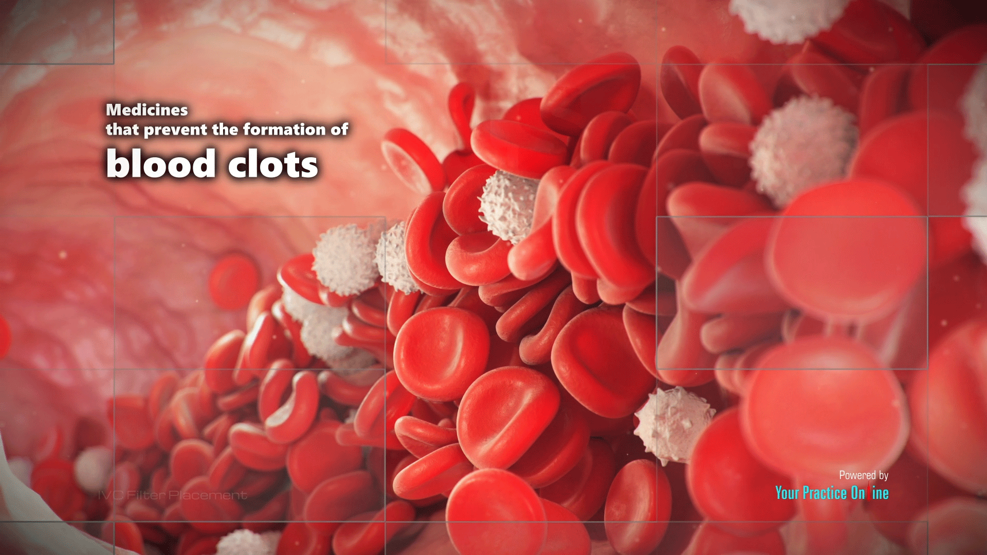 IVC Filter Placement Video Medical Video Library