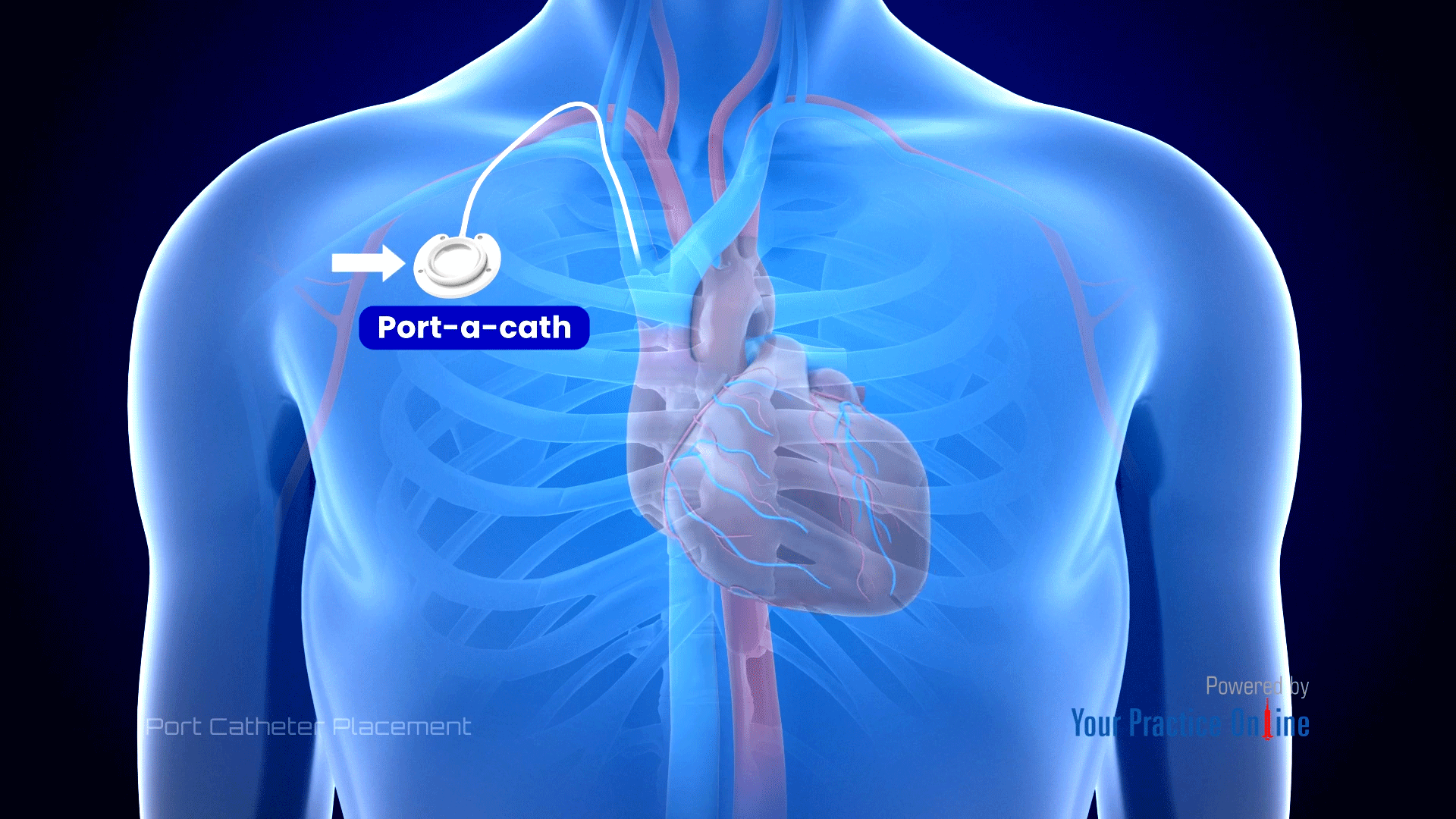 Port Catheter Placement Video Medical Video Library