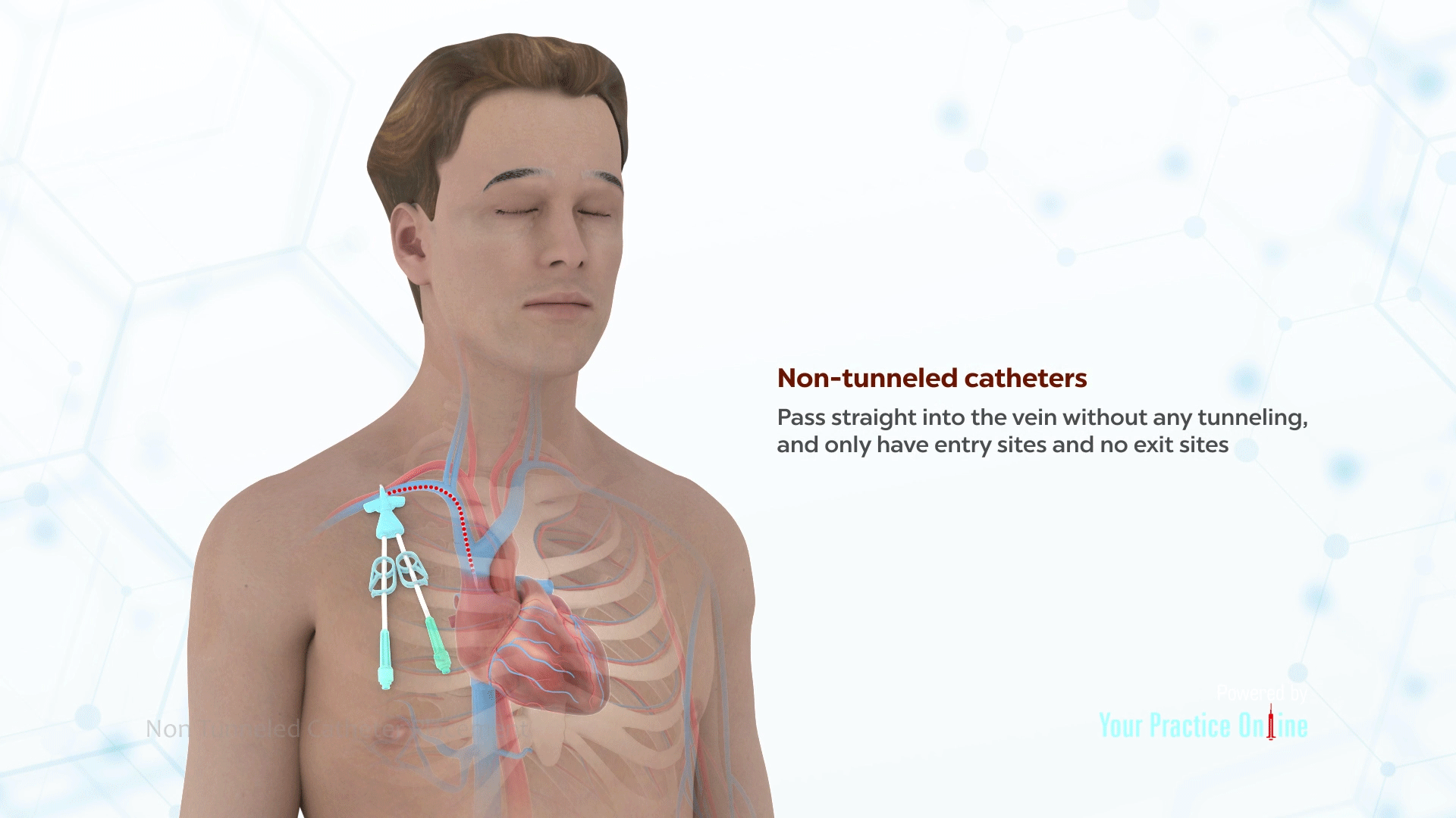 Non Tunneled Catheter Placement Video Medical Video Library
