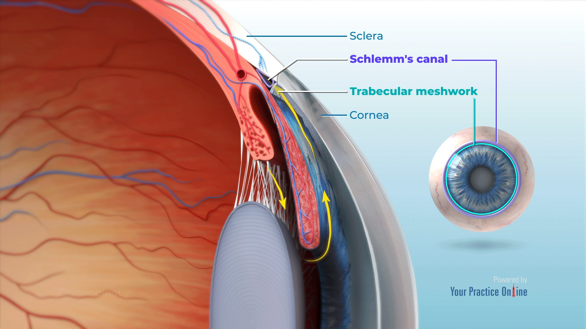 Canaloplasty Video | Medical Video Library