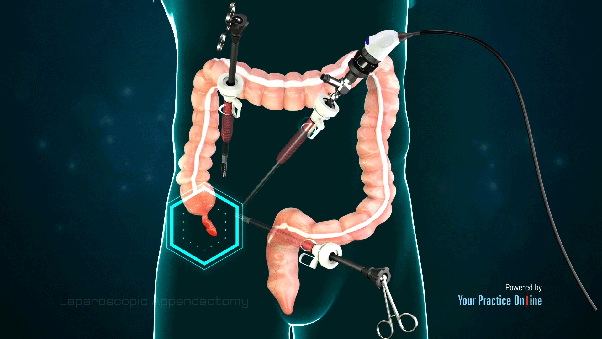 Laparoscopic Appendectomy Video | Medical Video Library