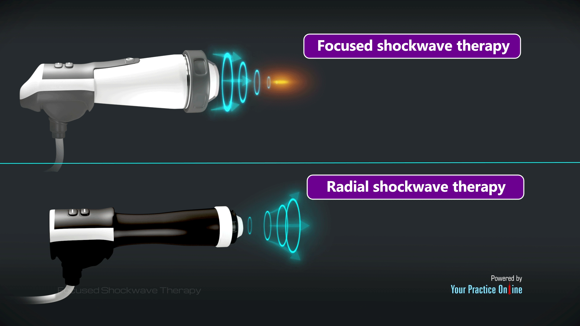 Focused Shockwave Therapy Video | Medical Video Library