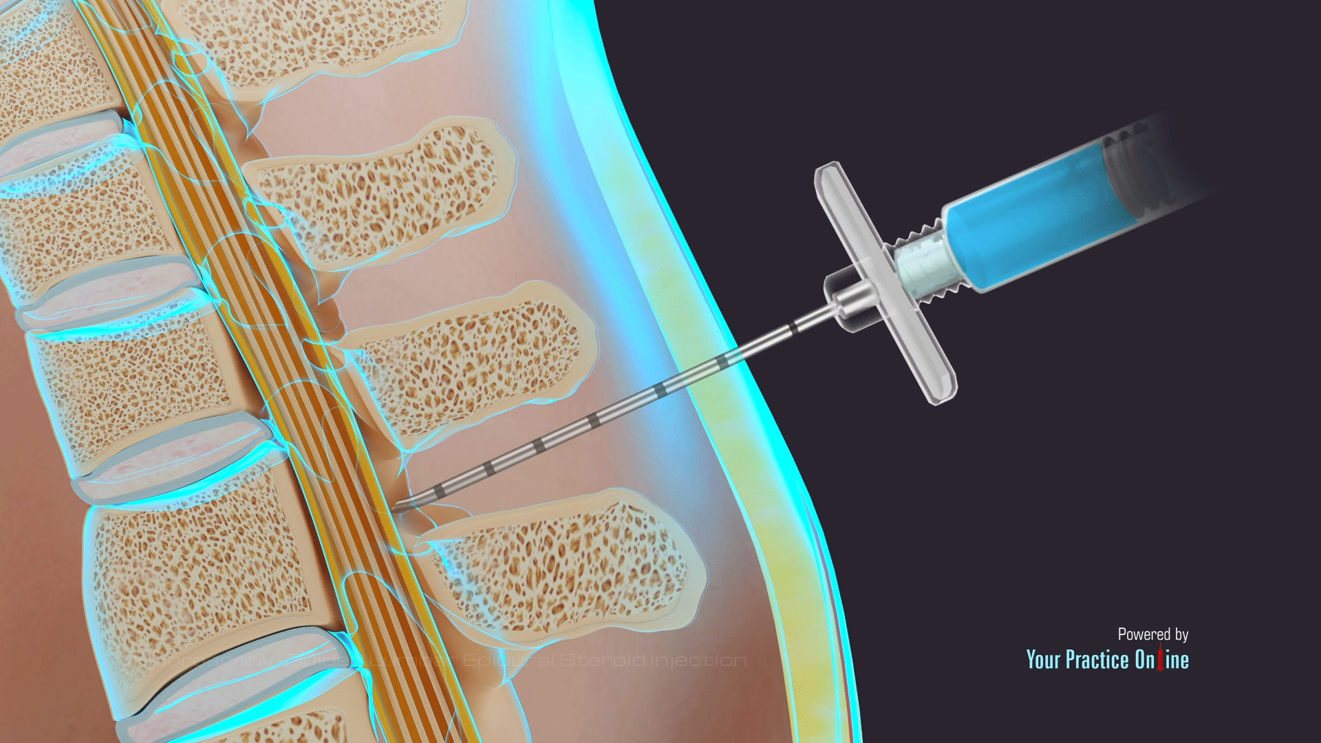 Fluoroscopy-Guided Lumbar Epidural Steroid Injection Video | Medical ...