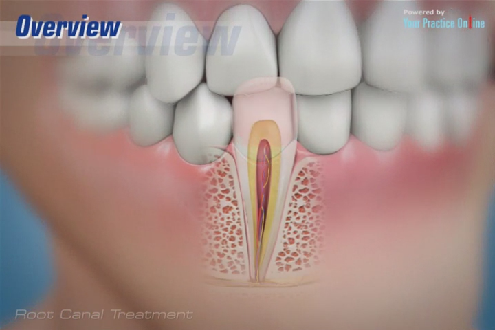 root canal video tooth decay treatment video dental video library root canal treatment